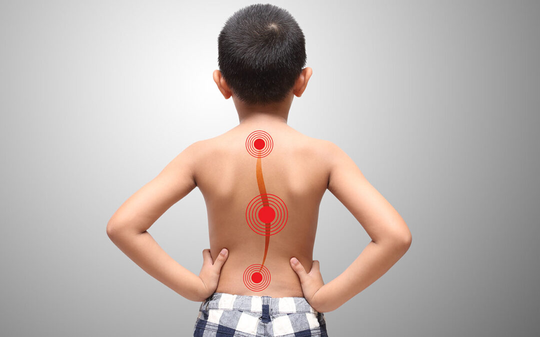 Chiropractische zorg bij klachten door een scoliose